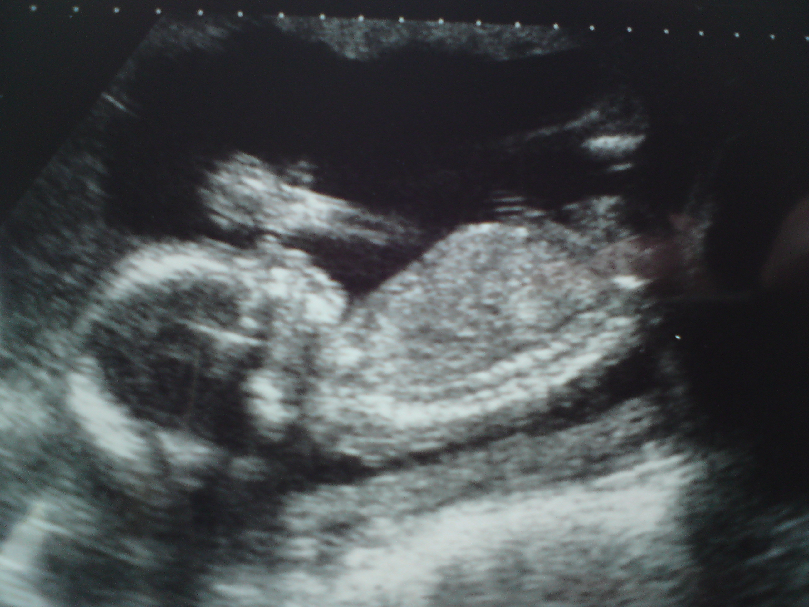 Baby @ 20 weeks